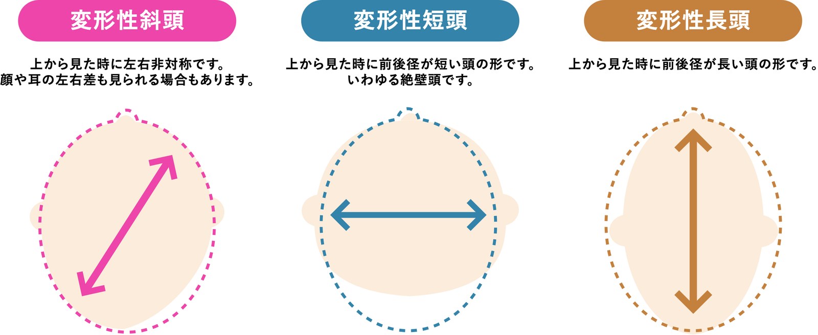 赤ちゃんの頭の変形の3タイプ（変形性斜頭・変形性短頭・変形性長頭）の図解