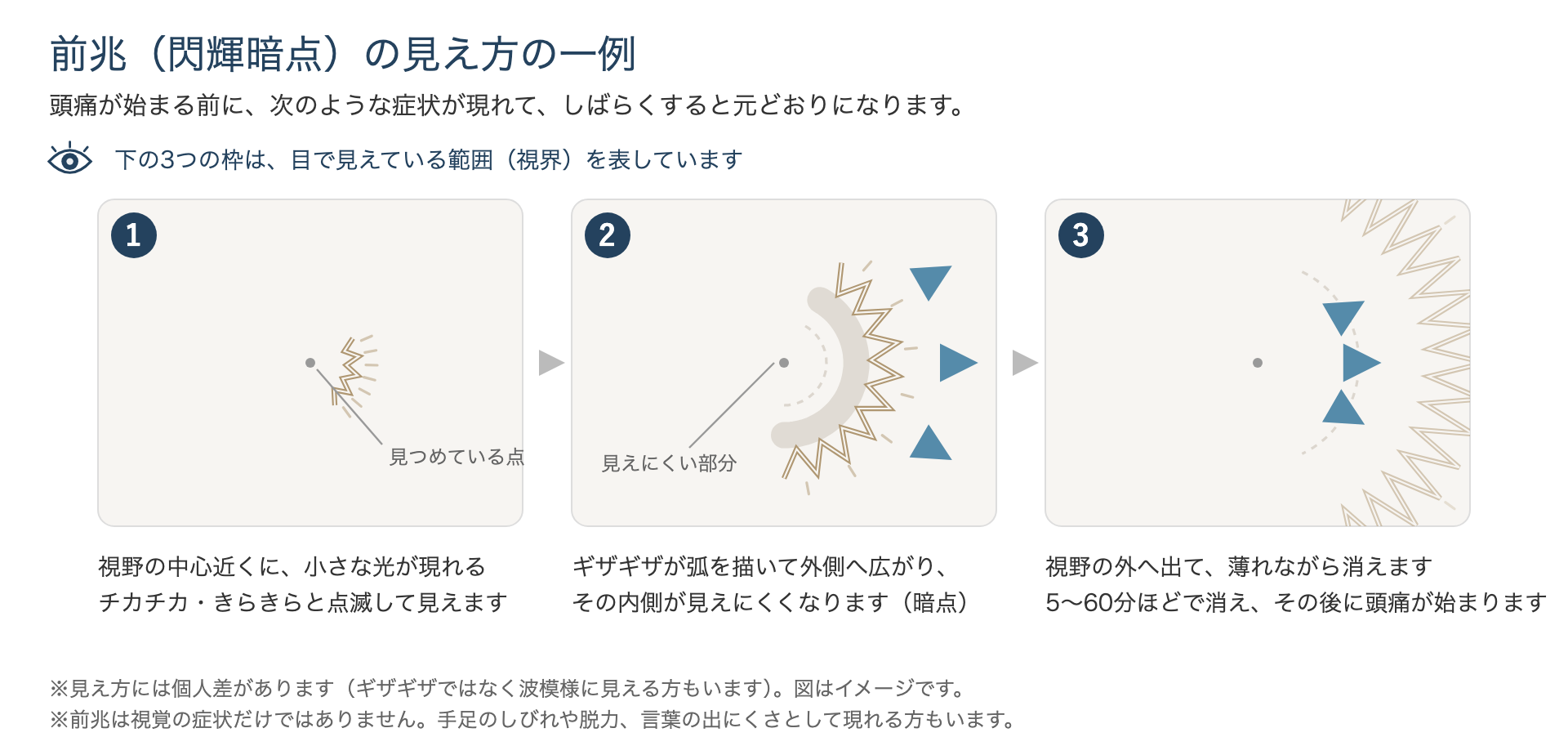 片頭痛の前兆・閃輝暗点の見え方（ギザギザの光が視野の外へ広がって消えるまで）